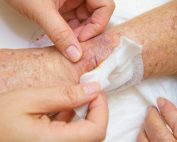 Elderly patient with wound