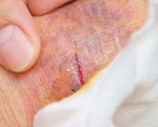 Elderly patient with wound