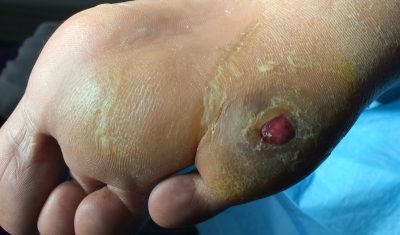 Case Study Foot Wound Image Figure 1
