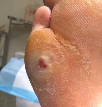 Case Study Foot Wound Image Figure 4
