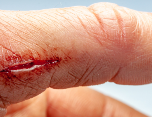 Wound Dehiscence and Surgical Dressings