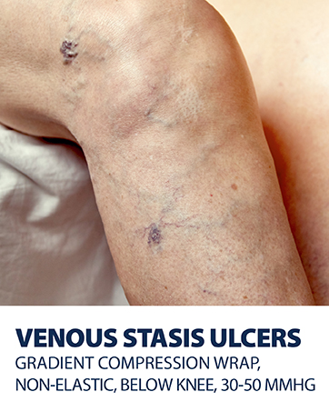 Venous stasis ulcers