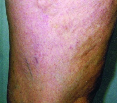Vericose veins in case study after image A