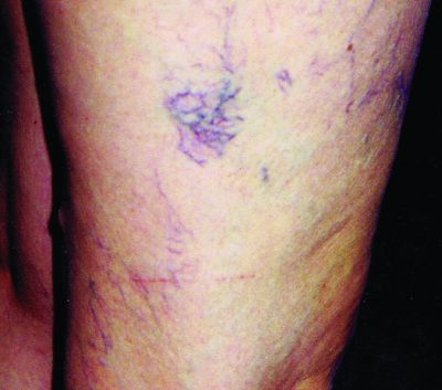 Vericose veins in case study before image A