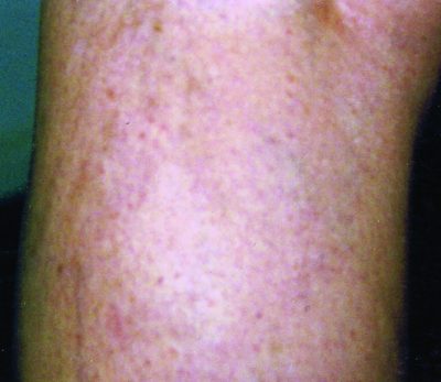 Vericose veins in case study before image B