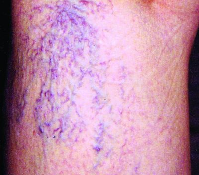Vericose veins in case study before image B