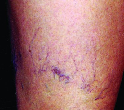 Vericose veins in case study before image C